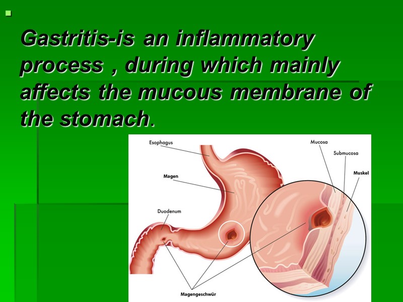 Gastritis-is an inflammatory process , during which mainly affects the mucous membrane of the